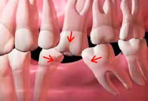 tooth teeth missing dental loss shifting implant extraction after due bite vs bridge consequences wisdom denture painless cost bad which