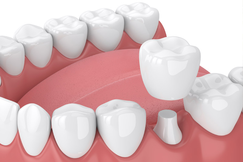 Dental Crowns in Mission